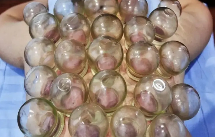 拔罐黑紫色