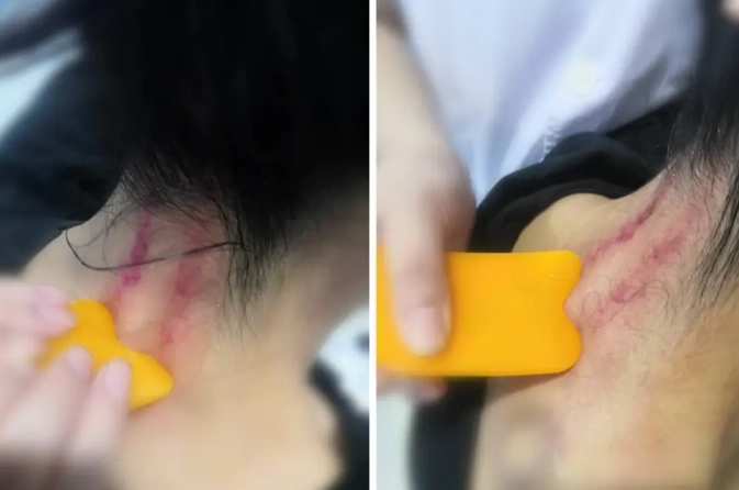刮痧後護理