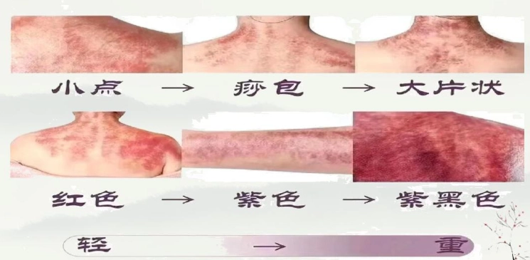 刮痧後護理
