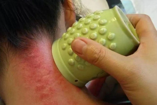 刮痧瘀青