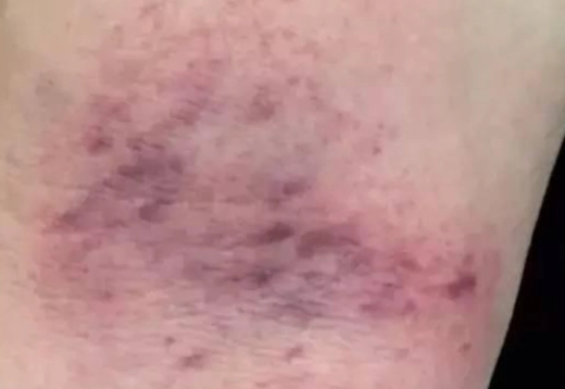 刮痧後瘀青正常嗎 刮痧後瘀青正常嗎