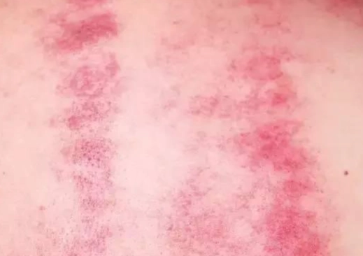 刮痧瘀青 刮痧瘀青