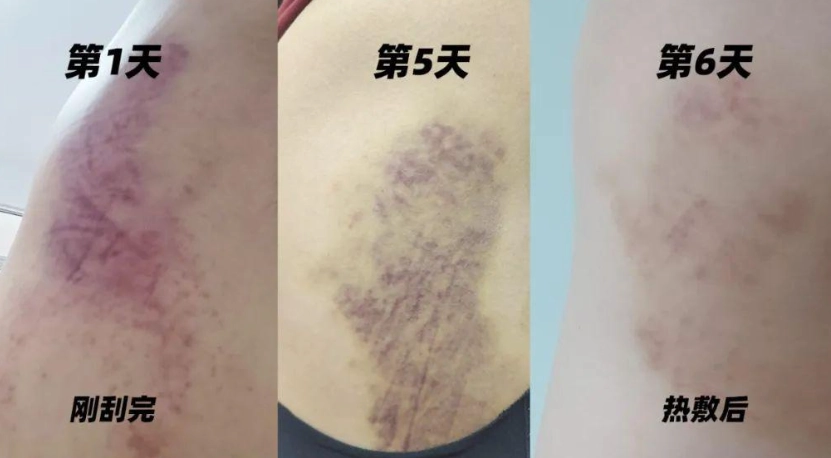 刮痧瘀青
