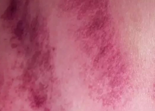 刮痧後瘀青正常嗎 刮痧後瘀青正常嗎