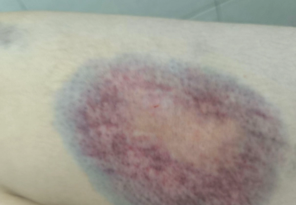 刮痧瘀青處理
