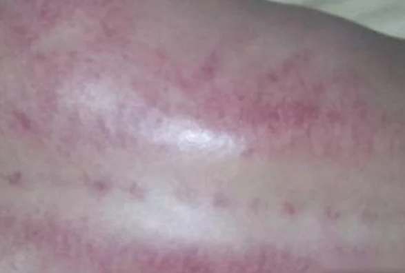 刮痧出痧快 刮痧出痧快