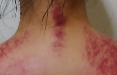 刮痧瘀血處理