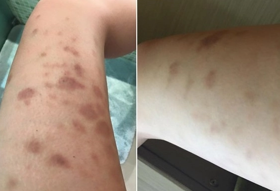 刮痧顏色代表什麼 刮痧顏色代表什麼