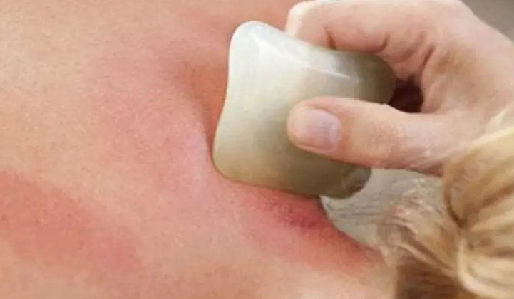 刮痧好處