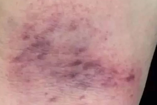 腿部刮痧後瘀青