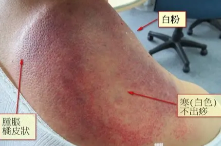 刮痧不出痧原因