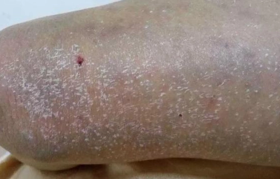 氣血瘀滯改善 氣血瘀滯改善