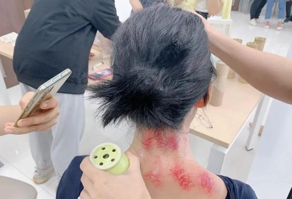 刮痧注意事項