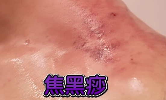 刮痧沒痧