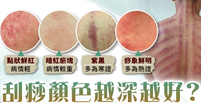 刮痧顏色意義