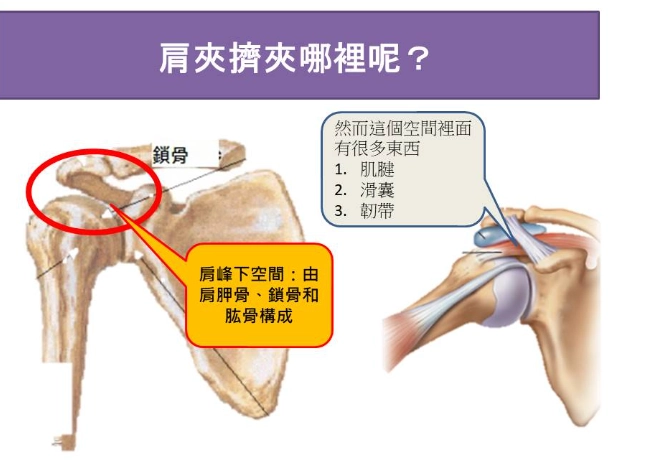 肩關節夾擠症候群 肩關節夾擠症候群